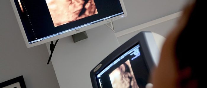 רשלנות רפואית במעקב ההריון