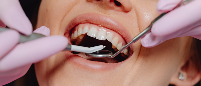 רשלנות רפואית בהשתלת שיניים